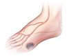 Foot complications of diabetes diabetes ulcers