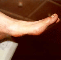 Charcot Foot