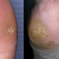 Callus & Corns