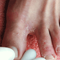 Athletes Foot