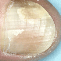 Onychomycosis