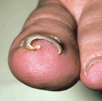 Ingrowing Toenail